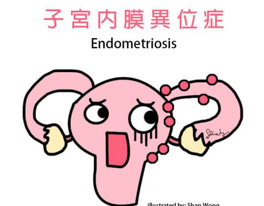 内膜异位症患者必看！烟台专科医院手术费用详解