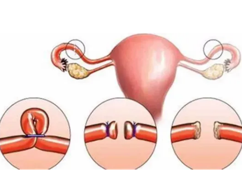 女性结扎之后仍有恢复生育的可能，这三种方法能帮助女性再次怀孕