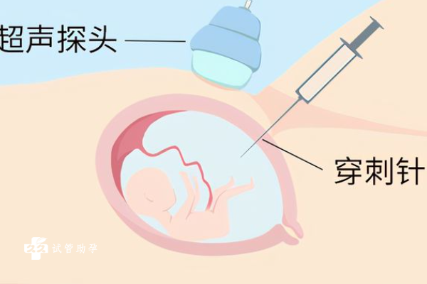 羊水穿刺和无创有什么区别？一文了解羊水穿刺过程及费用