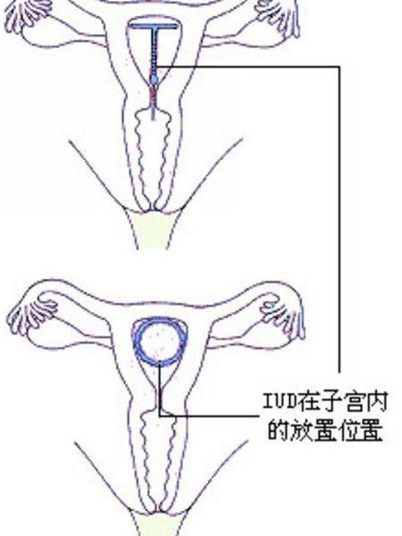 避孕环怎么放进宫内