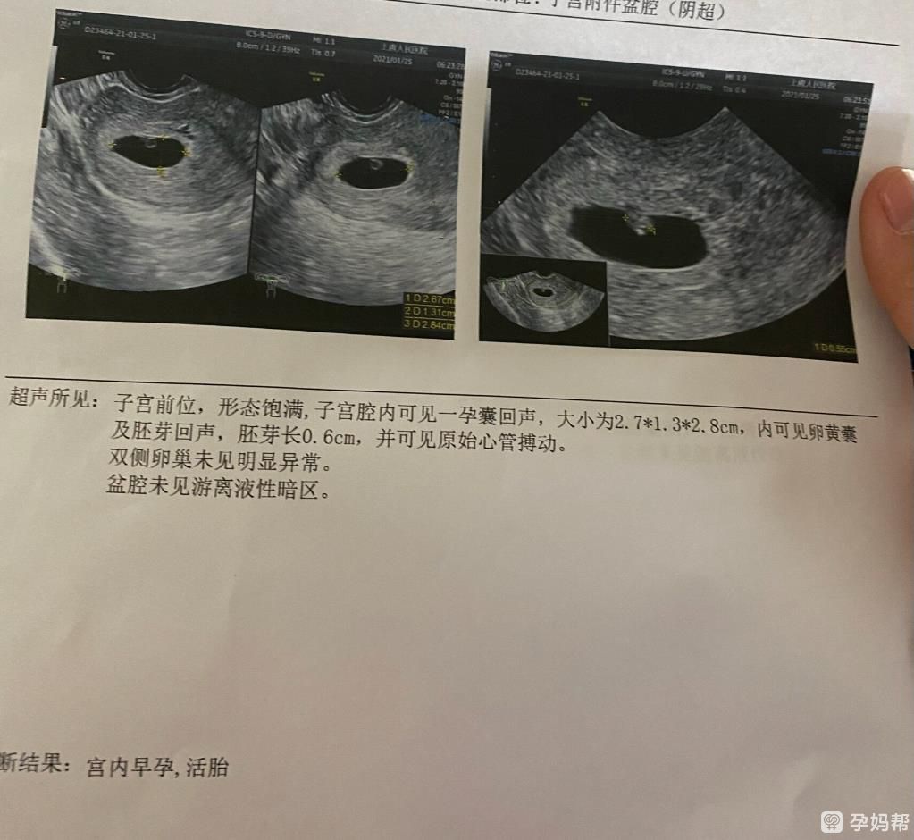 XY染色体孕囊图