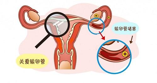 输卵管造影的利弊？有没有更好的检查方法？