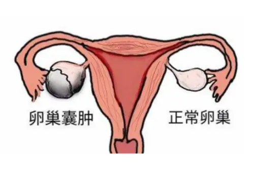 卵巢多个囊肿：卵巢多个囊肿严重吗?