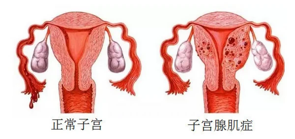 单角子宫做试管婴儿的步骤是什么