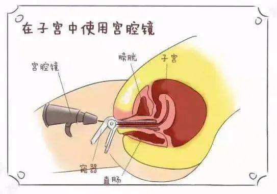 宫腔粘连是怎么形成的?对女性有哪些危害?