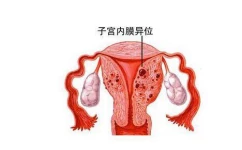 阿托西班对试管移植的作用盘点，能预防子宫收缩提高着床率