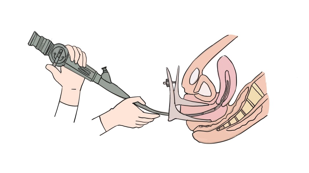 试管fet周期是囊胚还是冻胚移植?