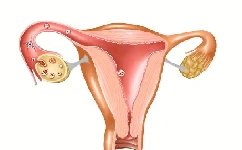 输卵管结核可以怀孕吗？怎么治疗好？