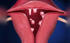 有子宫肌瘤和卵巢囊肿能怀孕吗  三代试管科普