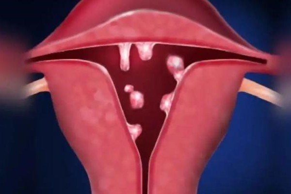 子宫内膜厚卵巢囊肿：子宫内膜厚卵巢囊肿盆腔积液?
