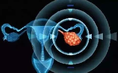 卵巢囊肿怎么治疗比较好？探索各种治疗方法！