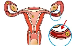 输卵管堵塞怎么治疗？能怀孕吗？