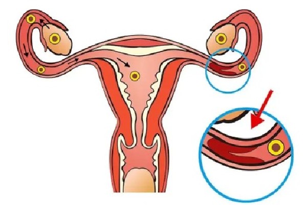 有卵巢囊肿6厘米，且怀孕4个月，怎么办  三代试管科普
