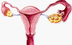 子宫内膜结核能不能试管，成功率多少?
