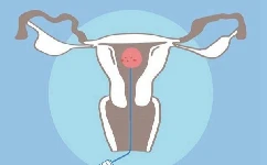 卵巢早衰是什么? 卵巢早衰还能拥有自己的小孩吗?