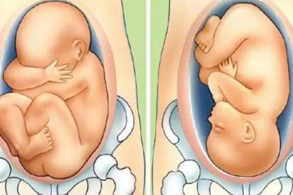 胎儿胎位示意图