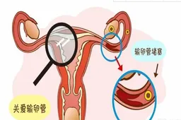 输卵管堵塞会引起不孕，常见的治疗方法有这几种