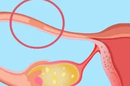 理解卵巢和输卵管切除的危害，谨慎决策！