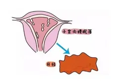内膜不规则增生是癌吗？子宫内膜增生是子宫内膜癌吗？