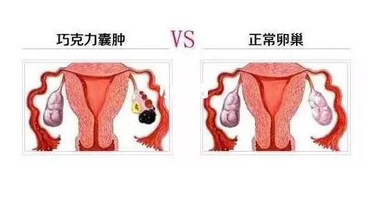 卵巢囊肿b超图：卵巢囊肿b超图片怎么看大小?