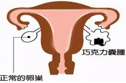 怀孕卵巢囊腔：卵巢囊腔是卵巢囊肿吗?