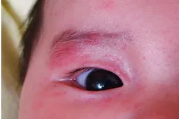 宝宝眼睛红肿痛该不该担心？眼睛是窗口也是很脆弱的器官！