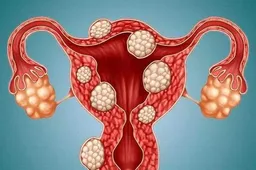 为什么医生不建议卵巢增大患者做囊胚移植？成功率是主要原因