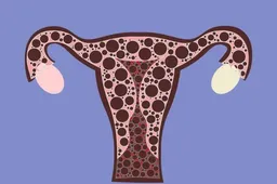 卵巢有囊肿的原因：卵巢囊肿的原因是怎么引起的?