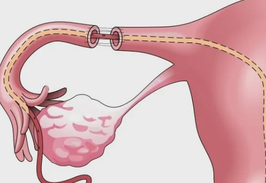 子宫切除了一半保留卵巢还可以做试管吗？