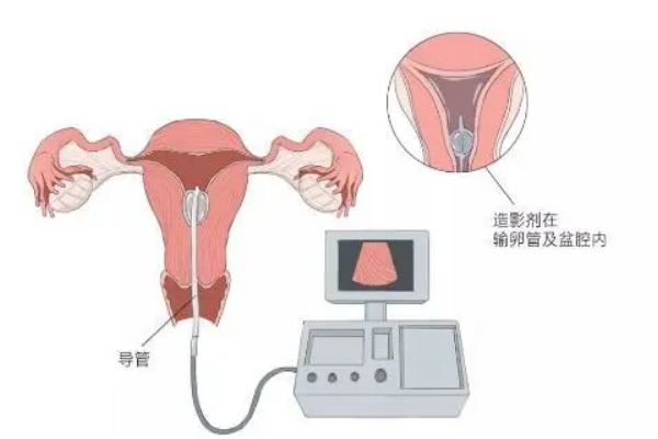 中医不建议做输卵管造影的原因，主要是因为对身体有很大伤害