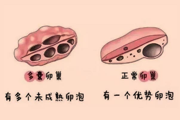 肌醇胆碱，多囊卵巢最佳克星！