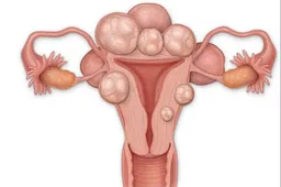 子宫肌瘤通常没有明显不适，常见的治疗方式有这三种