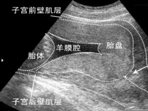 胎盘低置是否要卧床需根据症状来定