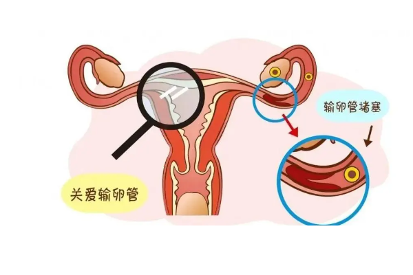 白带增多是输卵管堵塞的症状吗，本文为你解答