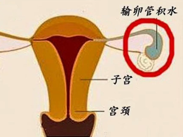 输卵管积水不能直接做试管婴儿