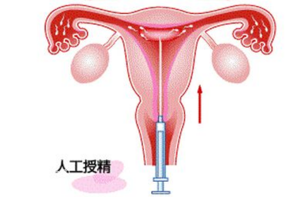 单身女性可以到泰国做人工授精，附人工授精的流程及费用