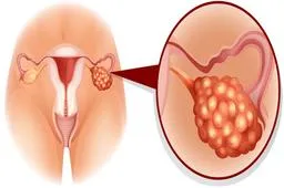 绝经后子宫内膜增厚怎么治疗？子宫内膜增厚有哪些治疗方法？