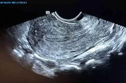 子宫肌瘤卵巢囊肿：子宫肌瘤卵巢囊肿是什么原因引起?