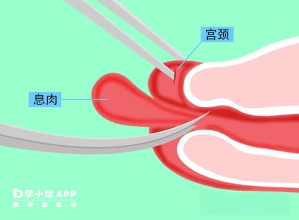 宫颈息肉磷化严重吗？