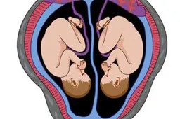 试管婴儿怀双胞胎12周后要做哪些检查？记住这三项千万别漏做！