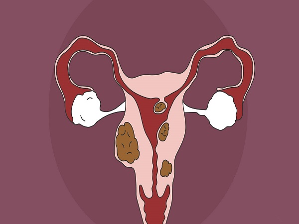 子宫肌瘤是女性常见的良性肿瘤