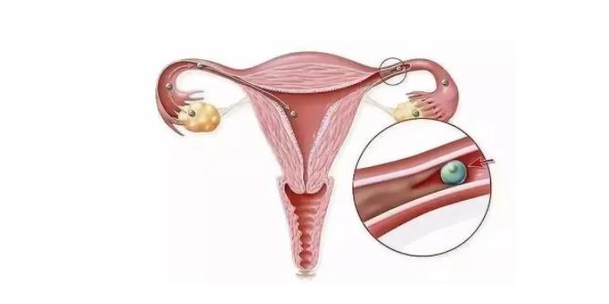 输卵管有粘连会不会影响怀孕