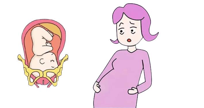 孕妇阴壁膨出对胎儿有影响吗