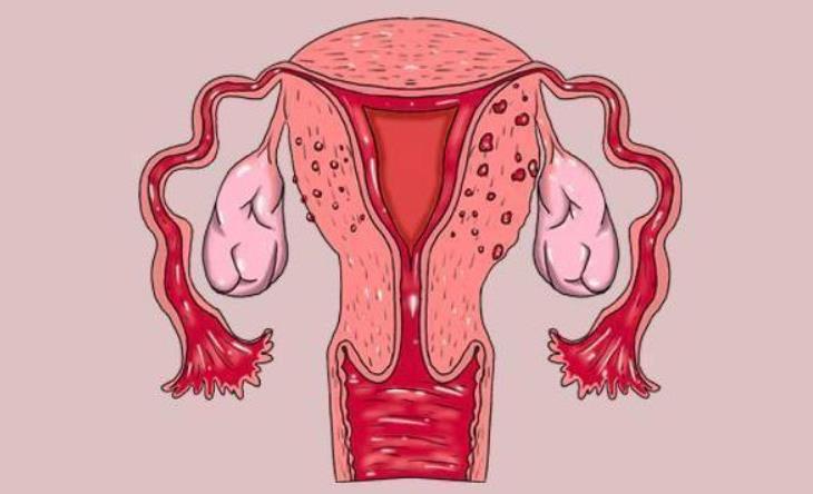 子宫内膜病变的症状有哪些
