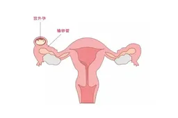 试管移植后出现宫外孕怎么办，这两种办法教你应对