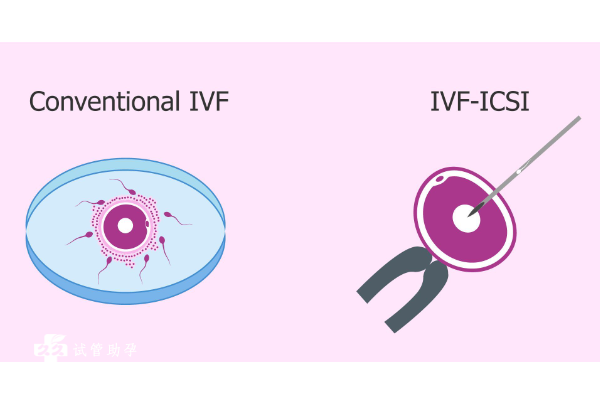 试管婴儿短方案流程是哪几步，细说分别需要花多长时间