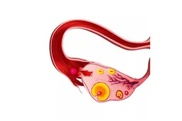 单侧卵巢对试管婴儿有什么影响，与双侧卵巢相比成功率较低