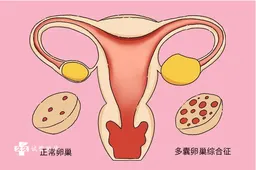 多囊卵巢做试管要花多长时间，取卵数量与成功率会受到这些影响