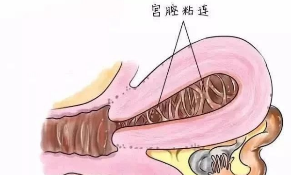 宫腔粘连对试管婴儿的影响