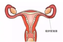 输卵管严重堵塞有什么征兆，教你判断和治疗输卵管堵塞的方法